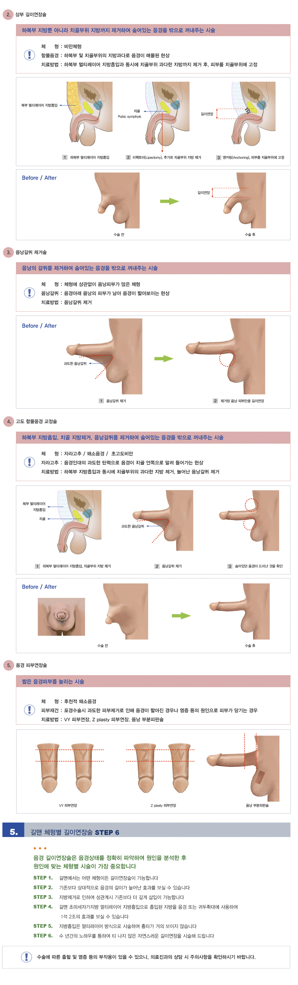 체형별 길이연장